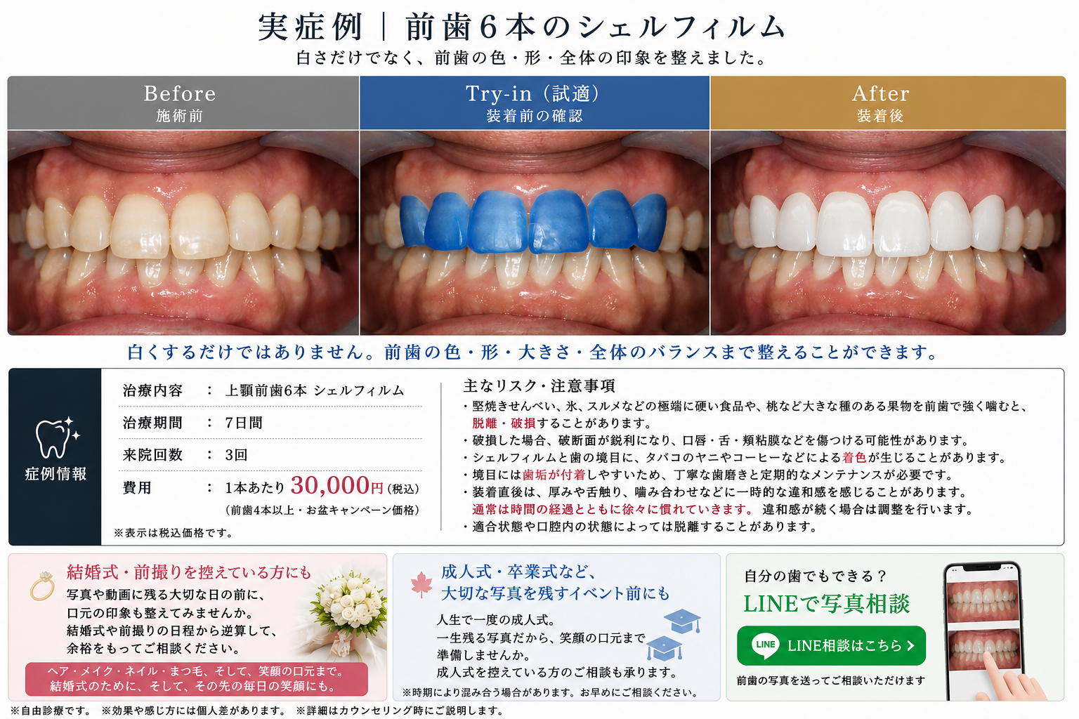 上顎前歯6本シェルフィルム症例 Before・試適・After